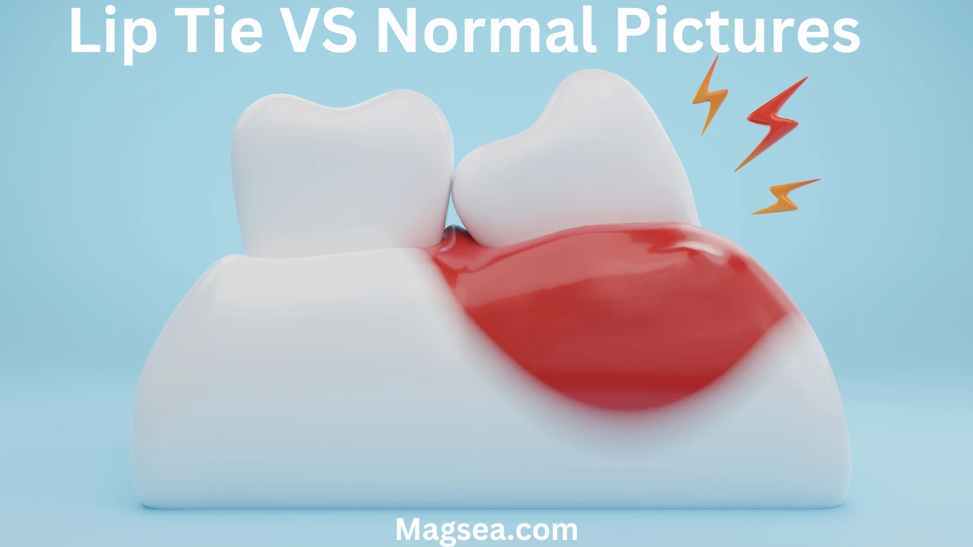 Lip Tie vs Normal Pictures: How to Spot the Difference in Your Baby ...