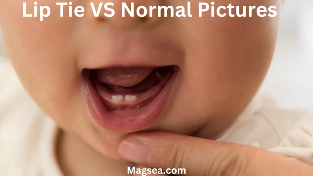 Treatment of Lip Tie in Infants